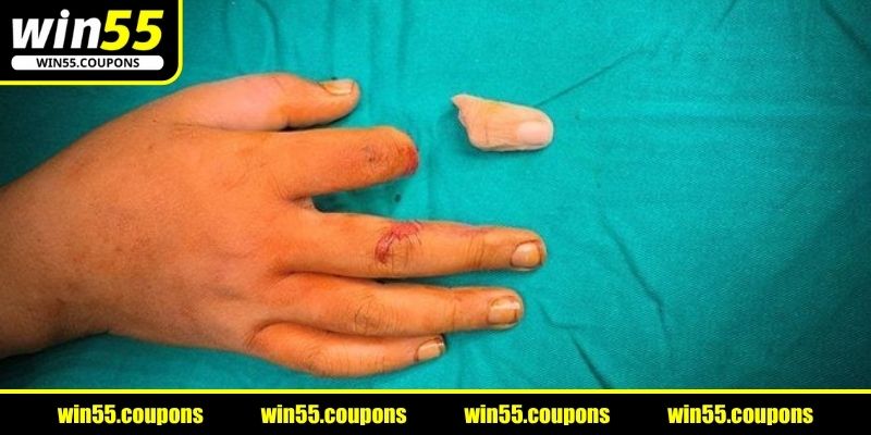nằm mơ thấy đứt tay trường hợp lìa ngón